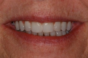 before and after dental procedure in greater houston