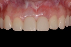 before and after dental procedure in greater houston