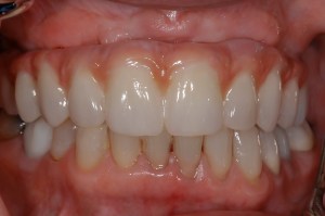 before and after dental procedure in greater houston