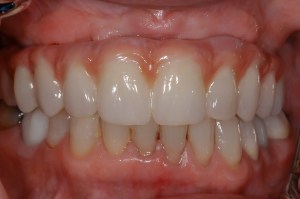 before and after dental procedure in greater houston
