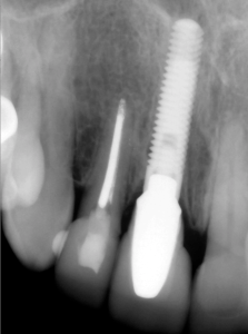 before and after dental procedure in greater houston