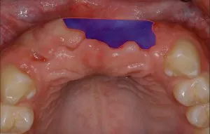 before and after dental procedure in greater houston