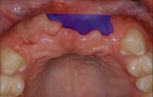 before and after dental procedure in greater houston