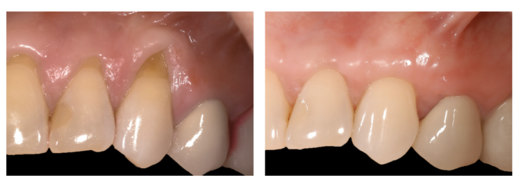 Gum Grafting