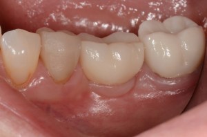 before and after dental procedure in greater houston