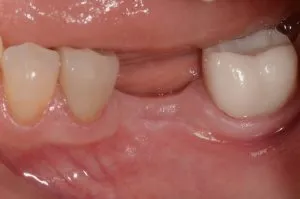 before and after dental procedure in greater houston