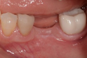 before and after dental procedure in greater houston
