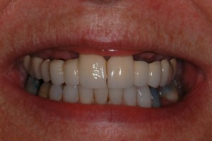 before and after dental procedure in greater houston