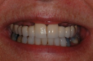 before and after dental procedure in greater houston