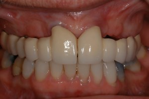 before and after dental procedure in greater houston