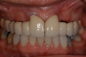 before and after dental procedure in greater houston