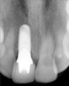 before and after dental procedure in greater houston
