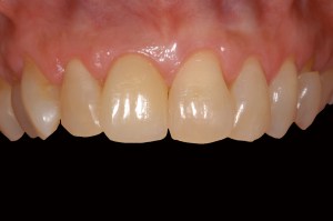 before and after dental procedure in greater houston