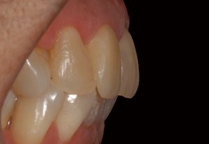 before and after dental procedure in greater houston