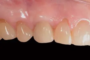 before and after dental procedure in greater houston