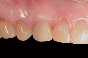 before and after dental procedure in greater houston