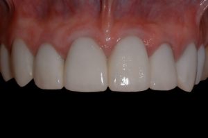 smile gallery front teeth