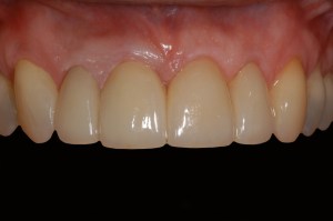 before and after dental procedure in greater houston